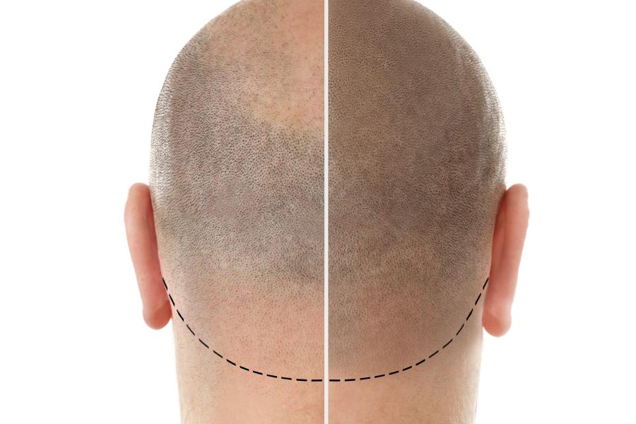 Image of Scalp Pigmentation